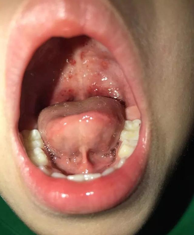 小儿疱疹性咽峡炎的症状有哪些孩子得了疱疹性咽峡炎怎么办