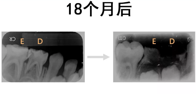 儿童牙齿保健的方法 怎么保护好孩子的牙齿健康