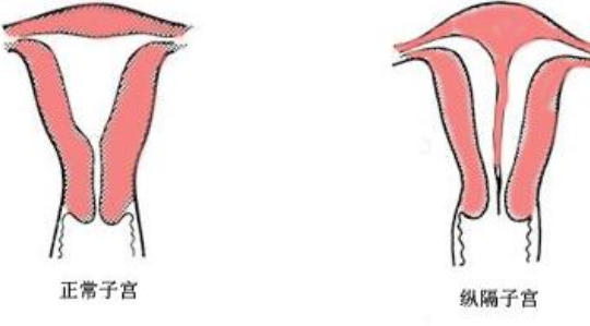 纵膈子宫治疗方法 子宫纵膈治疗一定要手术吗