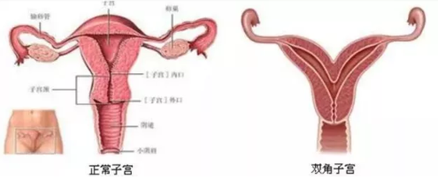 双角子宫对怀孕有哪些影响 怎么判断是不是双角子宫