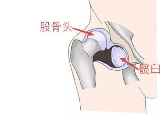 宝宝髋关节发育不良怎么办 髋关节发育不良的危害