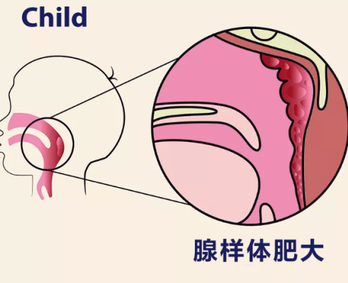 宝宝很小就打呼噜怎么回事 宝宝很小就打呼噜的原因