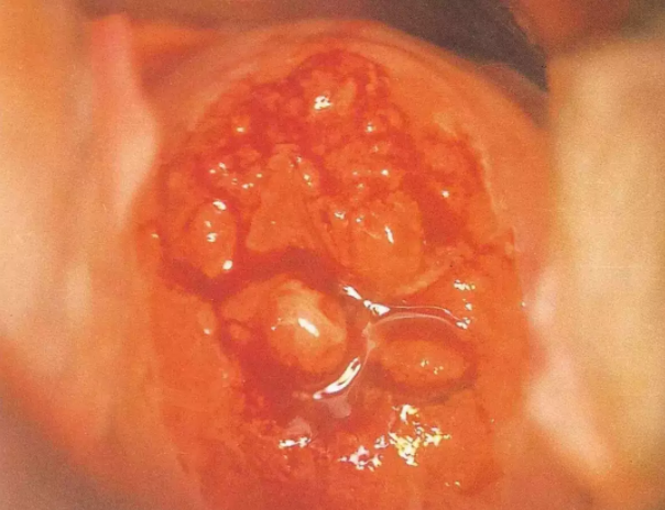 异常阴道镜宫颈是什么样子的 异常阴道镜宫颈图解