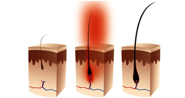 毛囊闭合还可以长出头发吗 判断毛囊健康的方法