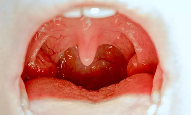 扁桃体大|扁桃体大就一定是扁桃体炎吗 扁桃体发炎有哪些症状