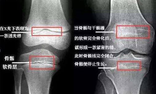 个子矮|个子矮和晚长个有什么区别 怎么分辨个子矮和晚长个