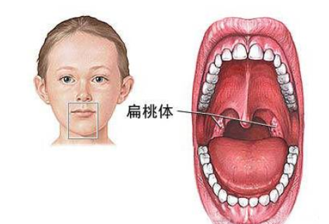 宝宝扁桃体自救指南 怎么保护孩子扁桃体