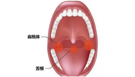 宝宝扁桃体自救指南 怎么保护孩子扁桃体