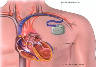 心源性猝死的主要原因是什么 心源性猝死是什么意思