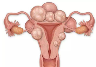 子宫肌瘤哪几种情况需要手术切除 子宫肌瘤需要开刀的几种情况