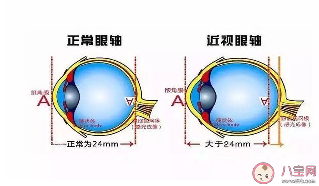 近视不能治愈是真的吗 近视多少度可能会导致失明