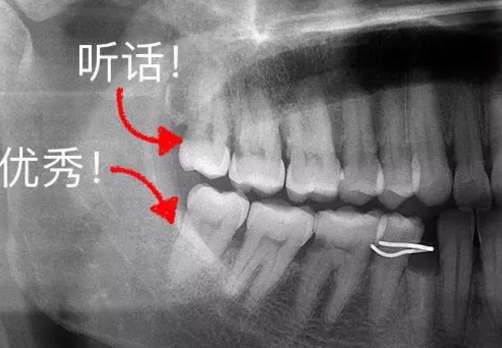 长智齿|长智齿了有多难受 长智齿了一定要拔牙吗