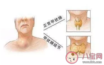 有甲状腺结节做什么检查 甲状腺结节多大需要动手术2020