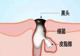 黑头是什么东西  黑头里挤出来的是什么东西