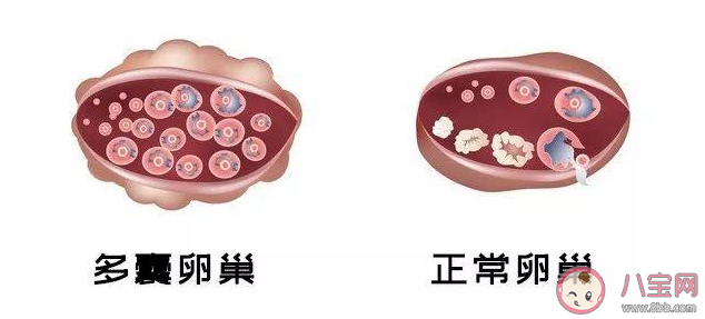 得了多囊卵巢还可以生育吗 多囊卵巢会影响生育吗