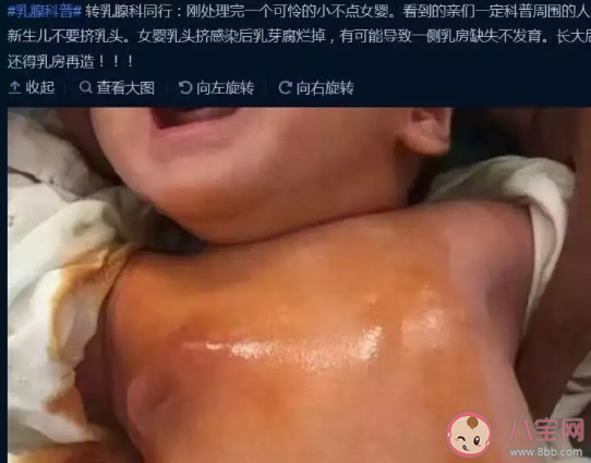 宝宝|宝宝刚生出来就挤乳头好吗新生女宝要不要挤乳头