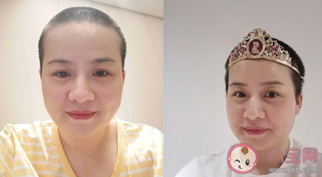 岳云鹏老婆为什么剃光头 剃光头是得了什么病