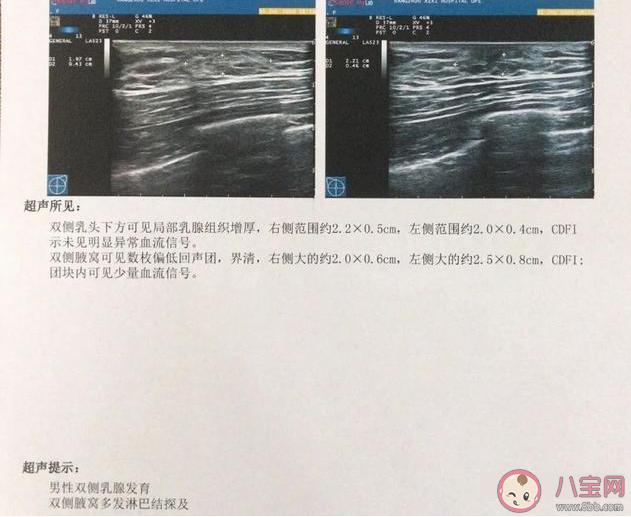 小伙健身3个月乳房发育是怎么回事 健身可以吃增肌营养粉吗