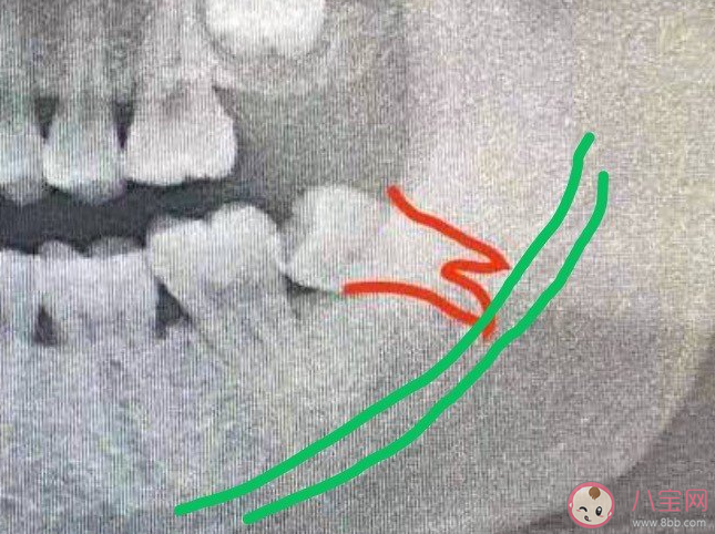 智齿能不能一次拔掉4颗 智齿没拔干净有事吗