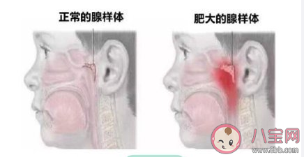 长期张嘴呼吸易致面容变丑张嘴呼吸有哪些危害