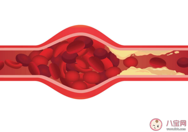 血液粘稠高有什么症状信号 血液粘稠怎么调理