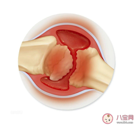 半月板手术后还能正常使用吗 半月板损伤能跑步吗