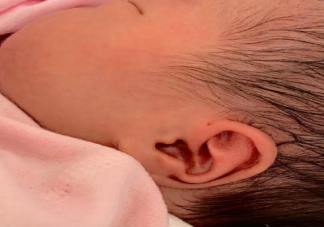 耳前瘘管感染一次就会反复发作吗 耳前瘘管反复感染应该怎么办