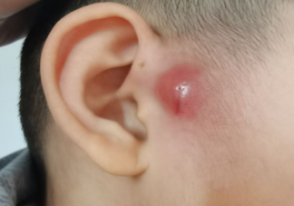 宝宝耳朵上的小孔流脓有分泌物是感染发炎了吗 耳前瘘管感染后一定要手术吗
