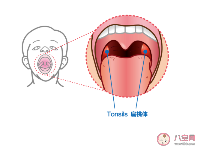 为什么扁桃体总是发炎 扁桃体经常发炎怎么办