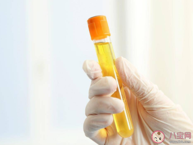 尿酸|常用尿酸检查方法有哪些 尿酸需要反复检查吗