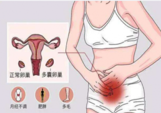 多囊卵巢综合症有多隐蔽 该如何应对多囊卵巢综合症