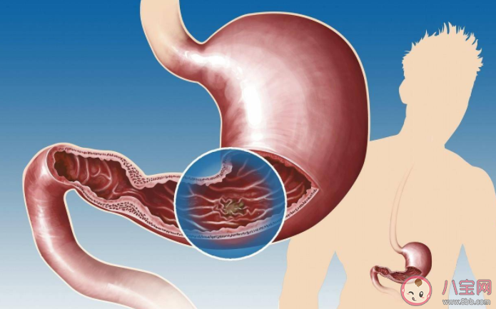 哪些人更易得胃癌 养胃攻略2022
