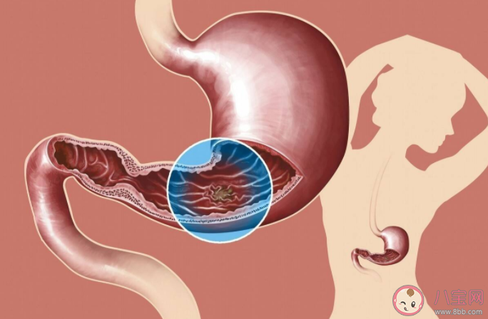 16岁女孩用零食代替三餐确诊胃癌 胃癌会让人的身体发生哪些变化
