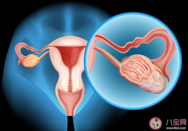 约70%卵巢癌患者确诊已是晚期 为什么卵巢癌难以发现