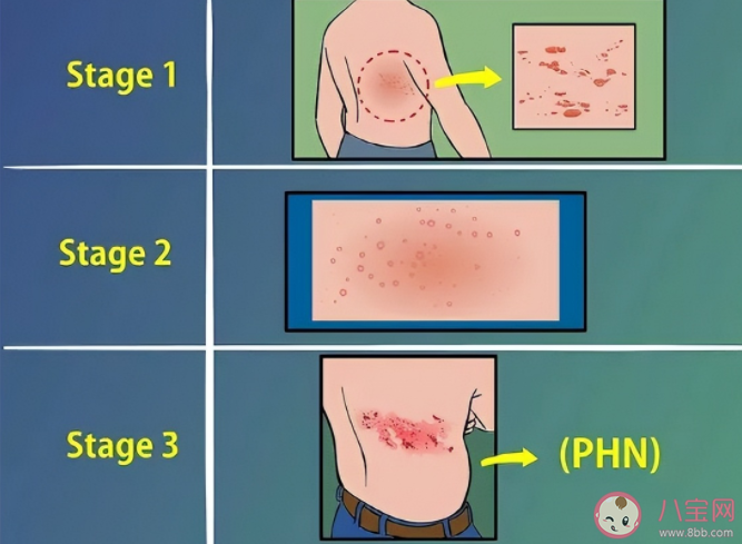 带状疱疹为什么那么痛 带状疱疹如何做好预防