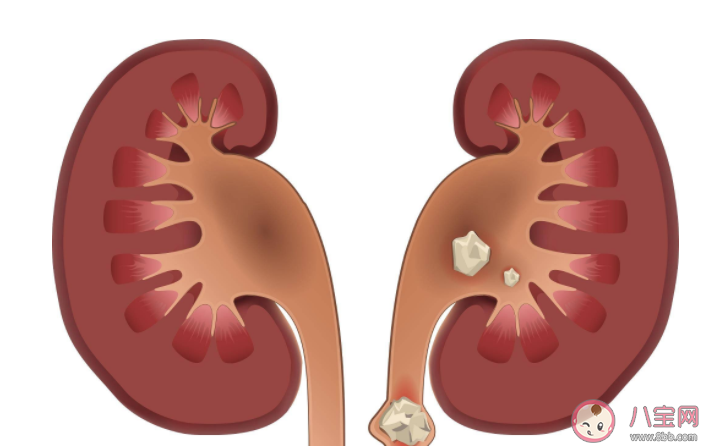 泌尿结石为什么容易夏天发生 哪些生活习惯更容易导致尿结石