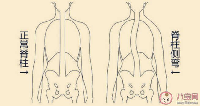 小朋友为何会脊柱侧弯 宝宝脊柱做什么检查判断