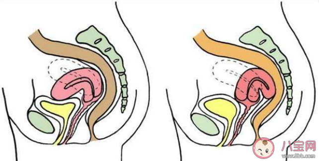 子宫前位更容易怀孕吗 子宫前位的女性该如何保养身体