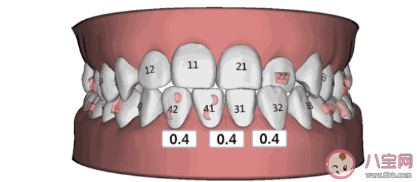 年龄越小戴牙套|年龄越小戴牙套效果越好吗 牙齿矫正的最佳年龄是几岁