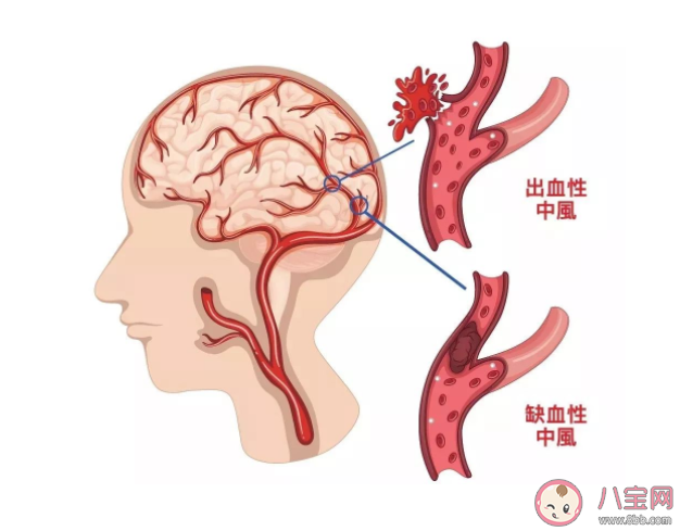 26岁女子长期熬夜导致脑出血 脑出血是怎么发生的