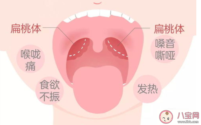 孩子扁桃体发炎怎么辨别 扁桃体日常如何护理