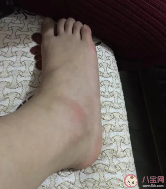 不小心崴到脚该冰敷还是热敷 崴脚以后如何处理好得快