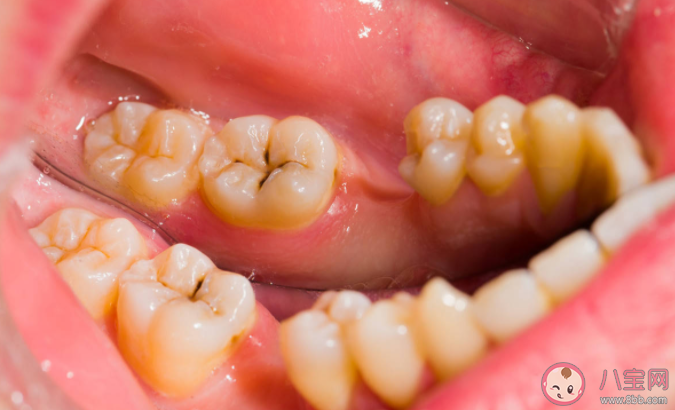 后牙槽上有黑线是什么 窝沟封闭可以预防窝沟龋坏吗