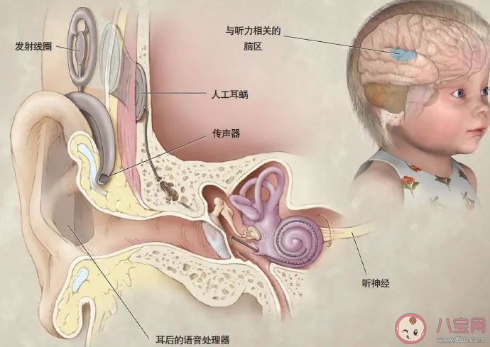 人工耳蜗为什么那么贵 装人工耳蜗能达到正常人的听力吗