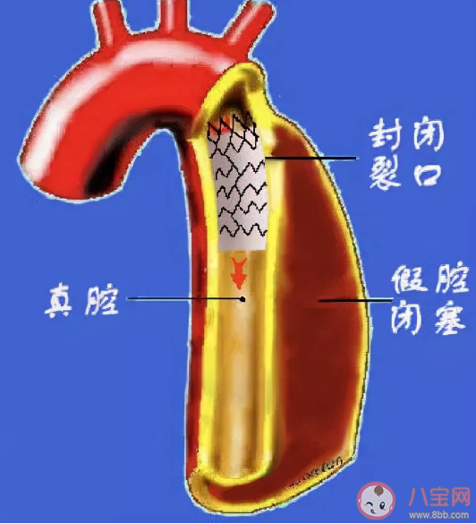 主动脉夹层有多危险 主动脉夹层高发人群有哪些