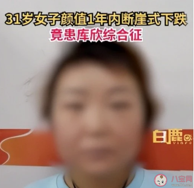 31岁女子越来越丑确诊罕见病 库欣综合征病因是什么