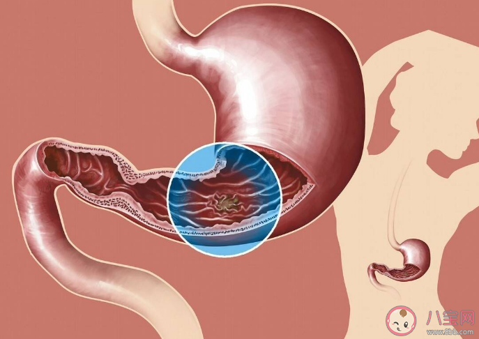 男子常有饥饿感一查患上胃癌 胃癌的发病原因有哪些