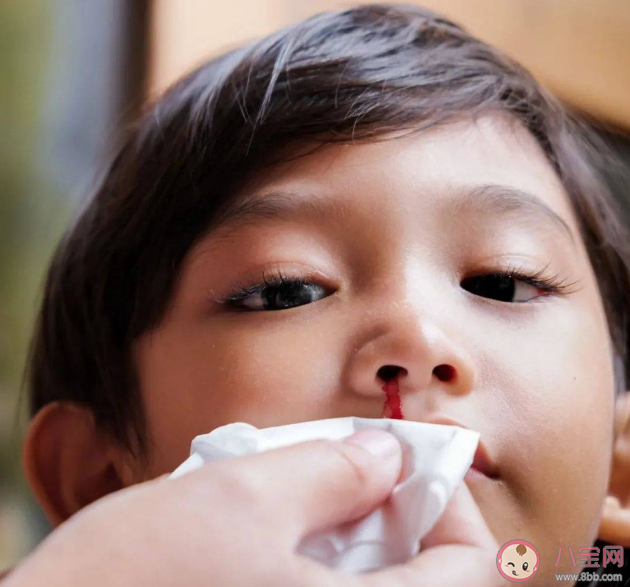 孩子流鼻血什么情况要留意 孩子流鼻血去医院挂什么科