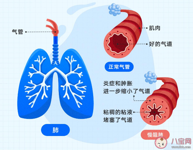 2022世界慢阻肺日主题是什么 为什么要关注慢阻肺