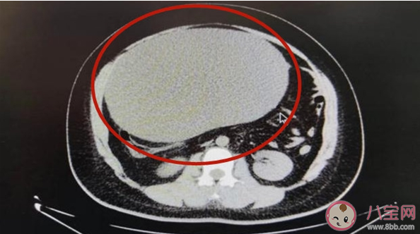 女子以为发胖肚中取出16斤囊肿 卵巢囊肿有哪些症状